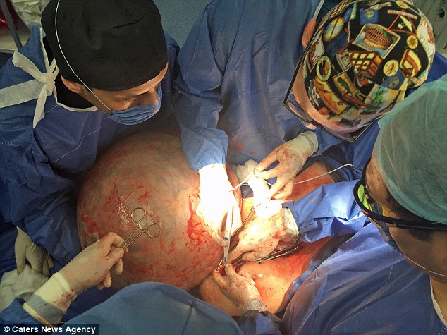 فريق من الاطباء يستخرجون الورم بدقة لمنع تسريبة داخل البطن