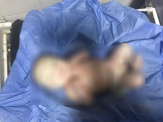 ولادة نادرة لطفل شمعي 