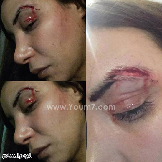 لبنى أبيضار تنشر صور تعرضها للضرب -اليوم السابع -11 -2015