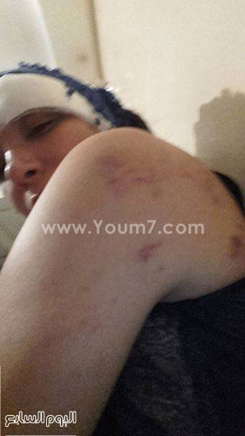 لبنى أبيضار توضح أثار الضرب على جسدها -اليوم السابع -11 -2015