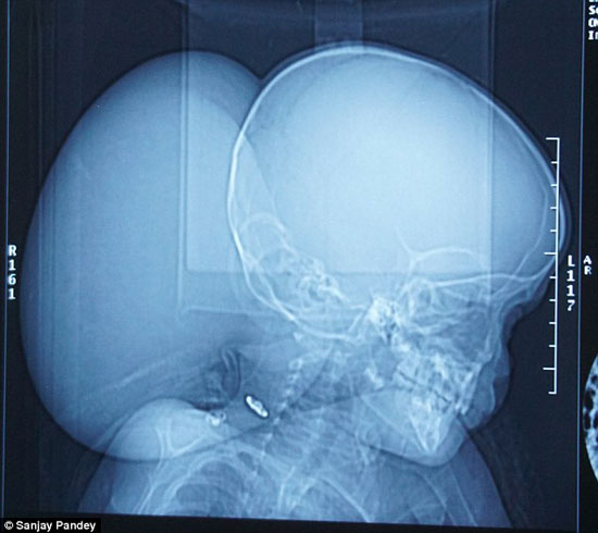 صورة الأشعة التى أجريت على رأس الفتاة -اليوم السابع -1 -2016