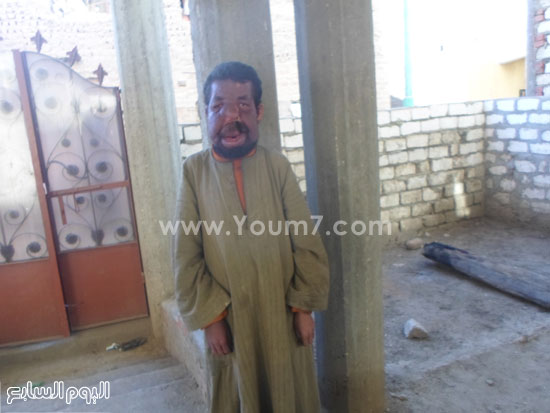 بالصور.. مأساة شاب بسوهاج ولد بمرض نادر عجز الأطباء عن تشخيصه.. "خالد بالصور.. مأساة شاب بسوهاج ولد بمرض نادر عجز الأطباء عن تشخيصه.. "خالد