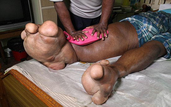 هندى ارون رازاسنيج أصيبت ساقه اليمنى بتضخم (3)