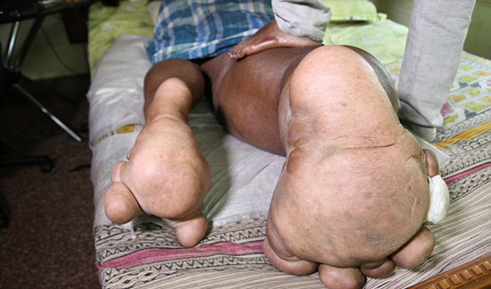 هندى ارون رازاسنيج أصيبت ساقه اليمنى بتضخم (5)
