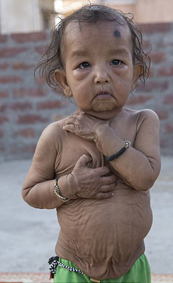 طفلان-فى-الهند-أصيبا-بمرض-نادر-(2)