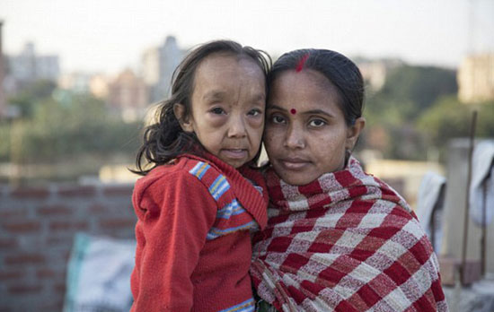 طفلان-فى-الهند-أصيبا-بمرض-نادر-(6)