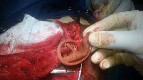 إجراء أول جراحة بناء أذن خارجية لمريض بمستشفى جامعة بنى سويف (1)