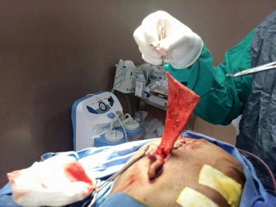 إجراء أول جراحة بناء أذن خارجية لمريض بمستشفى جامعة بنى سويف (3)