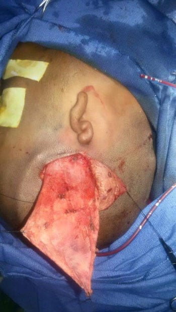 إجراء أول جراحة بناء أذن خارجية لمريض بمستشفى جامعة بنى سويف (8)