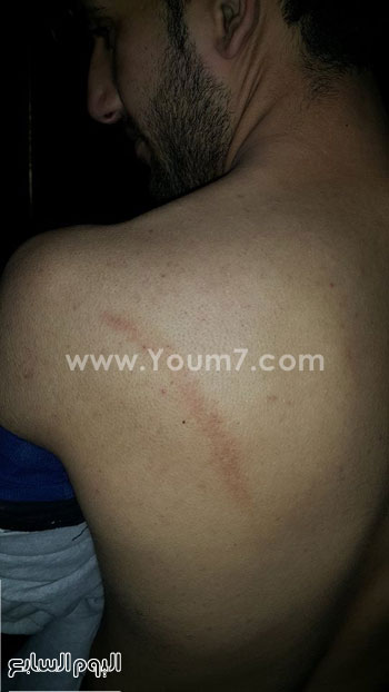 آثار الضرب على جسد عضو التيار الشعبى -اليوم السابع -4 -2015