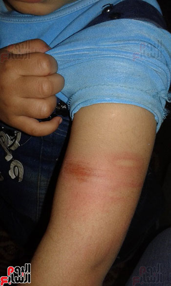 اتهام مدرسة بالتعدى على طفلة بـخرطوم وإصابتها بكدمات فى جسدها بالدقهلية (3)