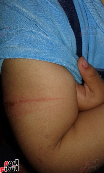 اتهام مدرسة بالتعدى على طفلة بـخرطوم وإصابتها بكدمات فى جسدها بالدقهلية (4)