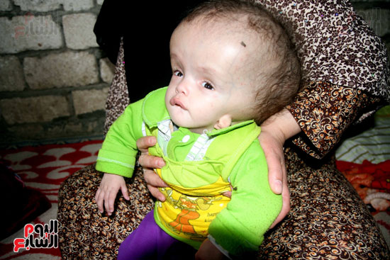 الطفلة فاطمة مريضه  بمياه على المخ (2)