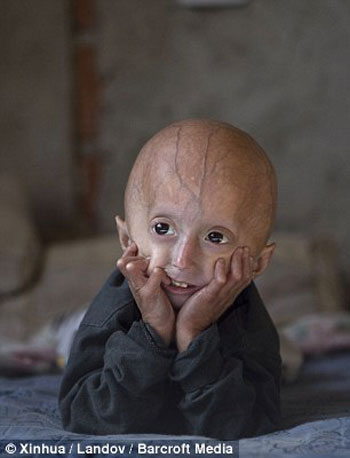 الطفل فرانكو الأرجنتينى المصاب بمرض البروجيريا النادر -اليوم السابع -5 -2015