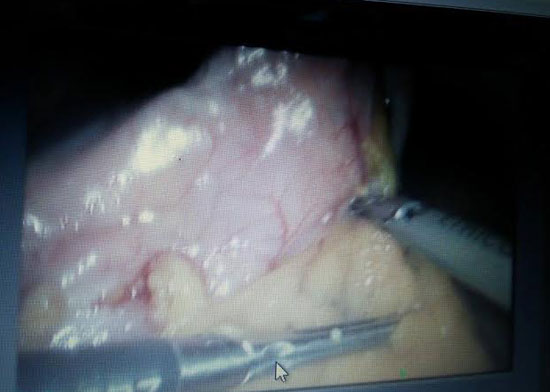 صورة توضح أثناء إجراء العملية الجراحية للمصابة بالمستشفى التعليمى العالمى بجامعة طنطا -اليوم السابع -5 -2015