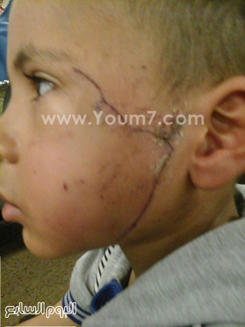 تورم وجه الطفل لعدم حصوله على الدواء -اليوم السابع -7 -2015