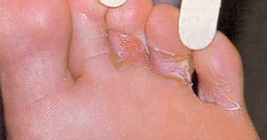 ما علاج التهاب الفطريات فى أظافر القدم؟