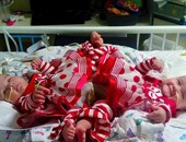 بالصور.. نجاح جراحة نادرة لفصل طفلتين ملتصقتين بمنطقة الحوض استمرت 15 ساعة