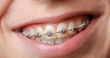 بروفيسور بريطانى: التقويم يسبب أضرارا باللثة وتراكم البلاك على الأسنان