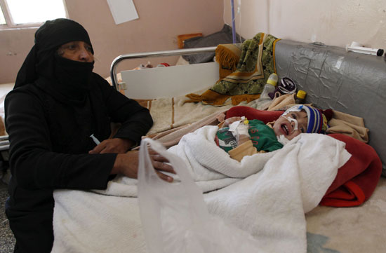 سوء التغذية يهدد مليون ونصف طفل يمني بالموت بسبب الحرب 