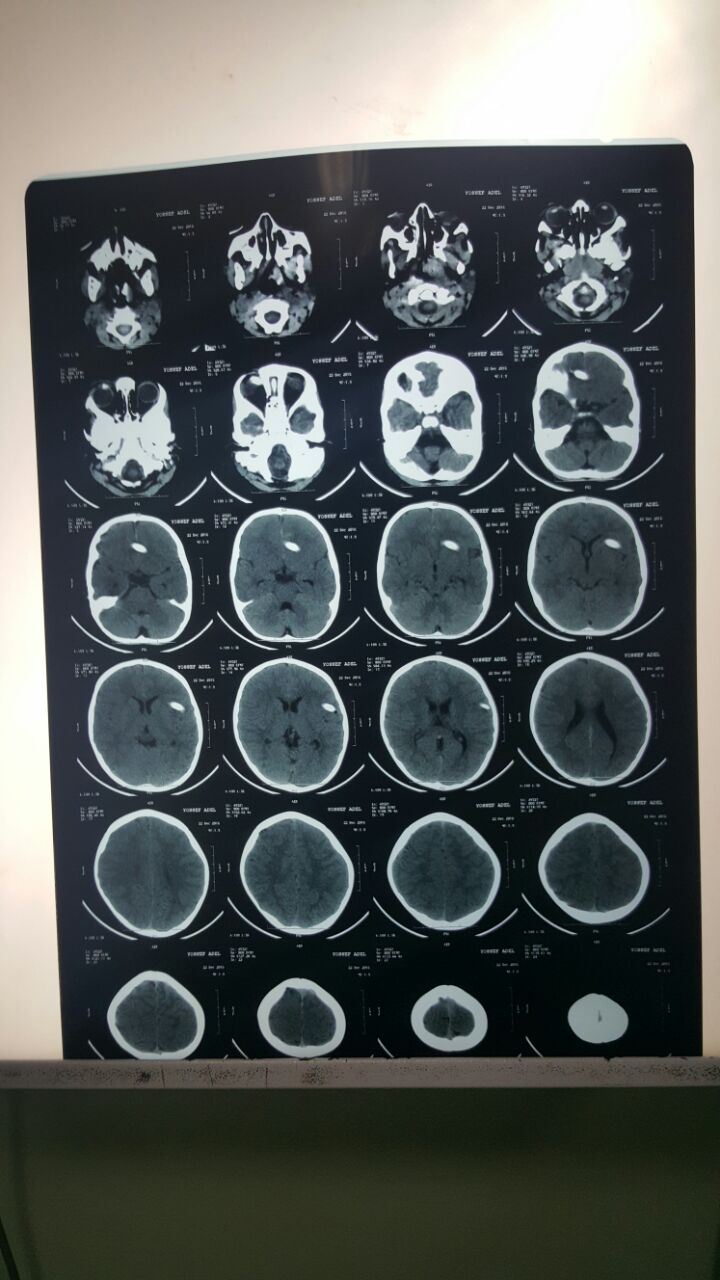 صورة الأشعة لمخ الطفل