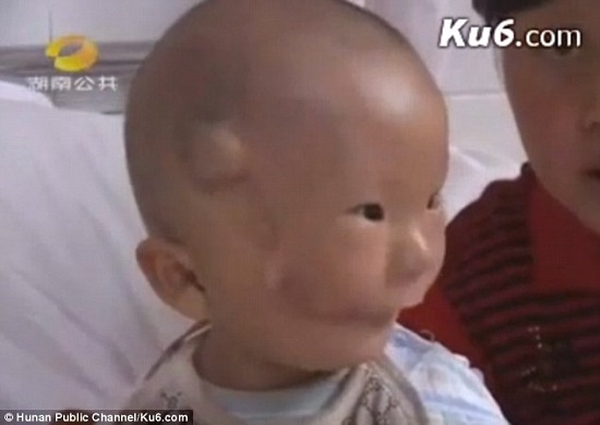 الطفل الصيني بعد خضوعه لعملية بالمستشفى