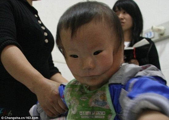 الطفل الصيني يعانى من مرض نادر