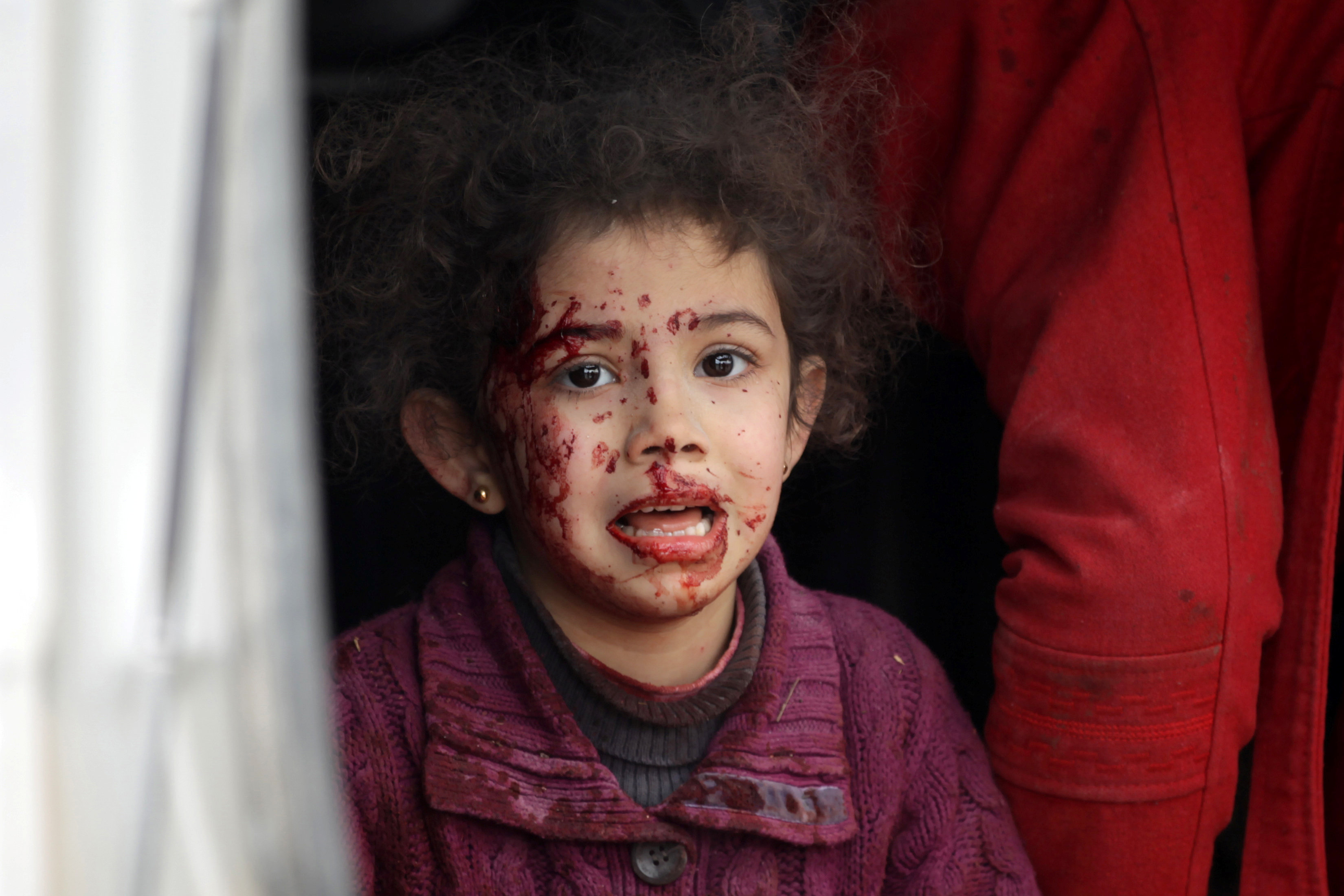 طفله سورية مصابة