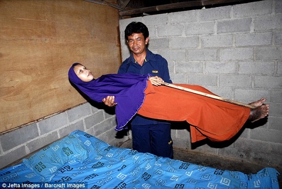 امرأة إندونيسية  تعاني من حالة نادرة تتركها غير قادر تماما على التحرك