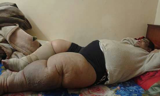 المريض عمرو علي وزنه 300 كيلو والاسعاف ترفض نقله