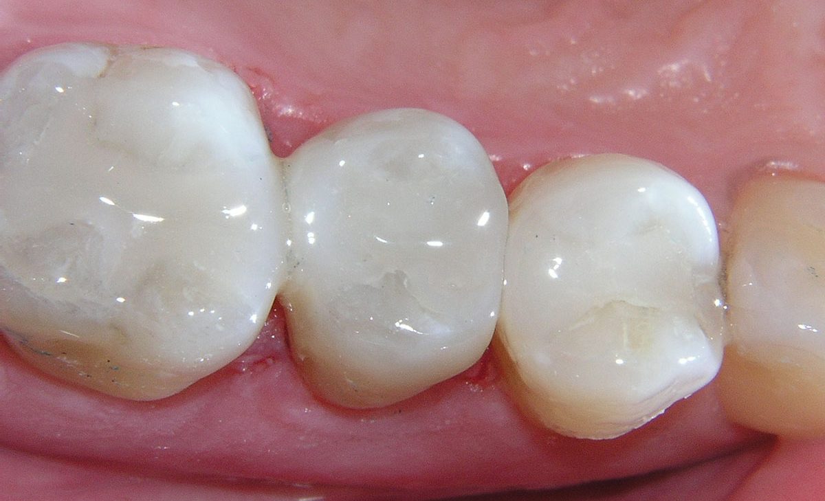 حشوة الاسنان البيضاء