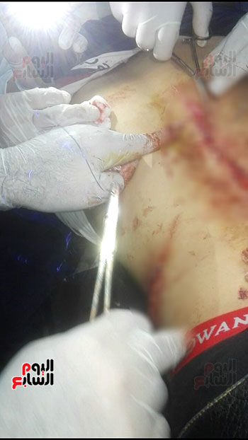 إصابة الطالب بـ 60 غرزة