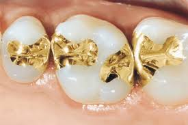 حشوة الاسنان الذهبية