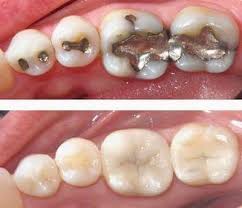 حشوة الاسنان الفضية