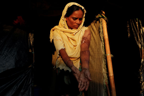 فتاة من الروهينجا بعد تعذيبها
