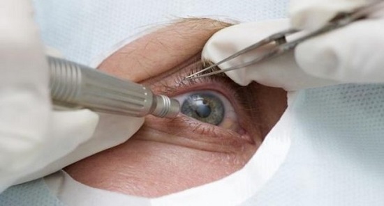 cataract-surgery-main-image-655x353