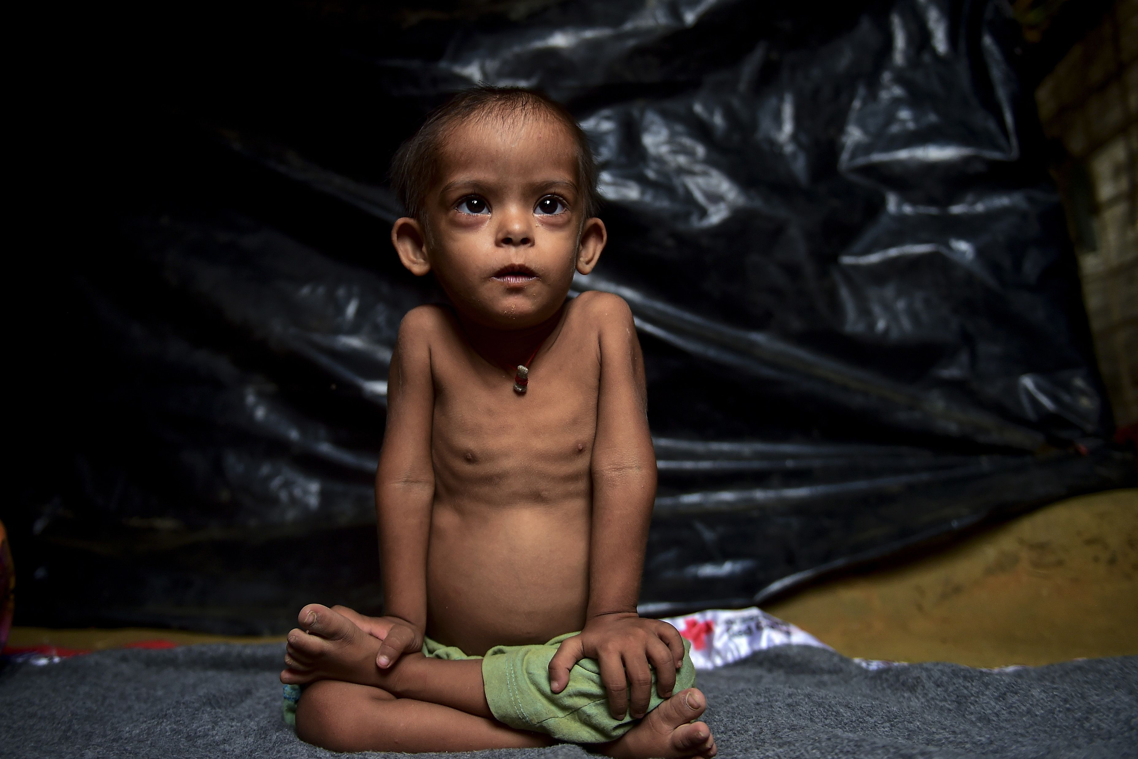 آثار سوء التغذية تظهر على جسد طفل من مسلمى الروهينجا