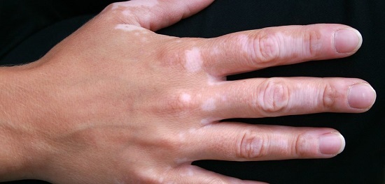 Vitiligo-of-Hands-1000x480