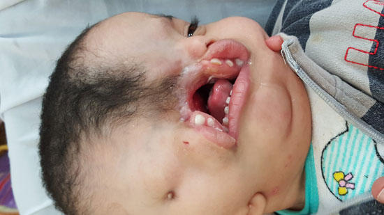  طفل يعانى من مرض نادر يحتاج لعلاج خارج مصر (2)