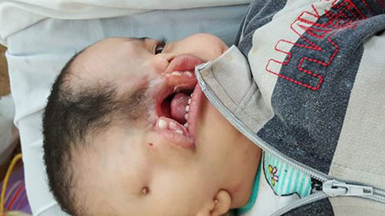  طفل يعانى من مرض نادر يحتاج لعلاج خارج مصر (1)