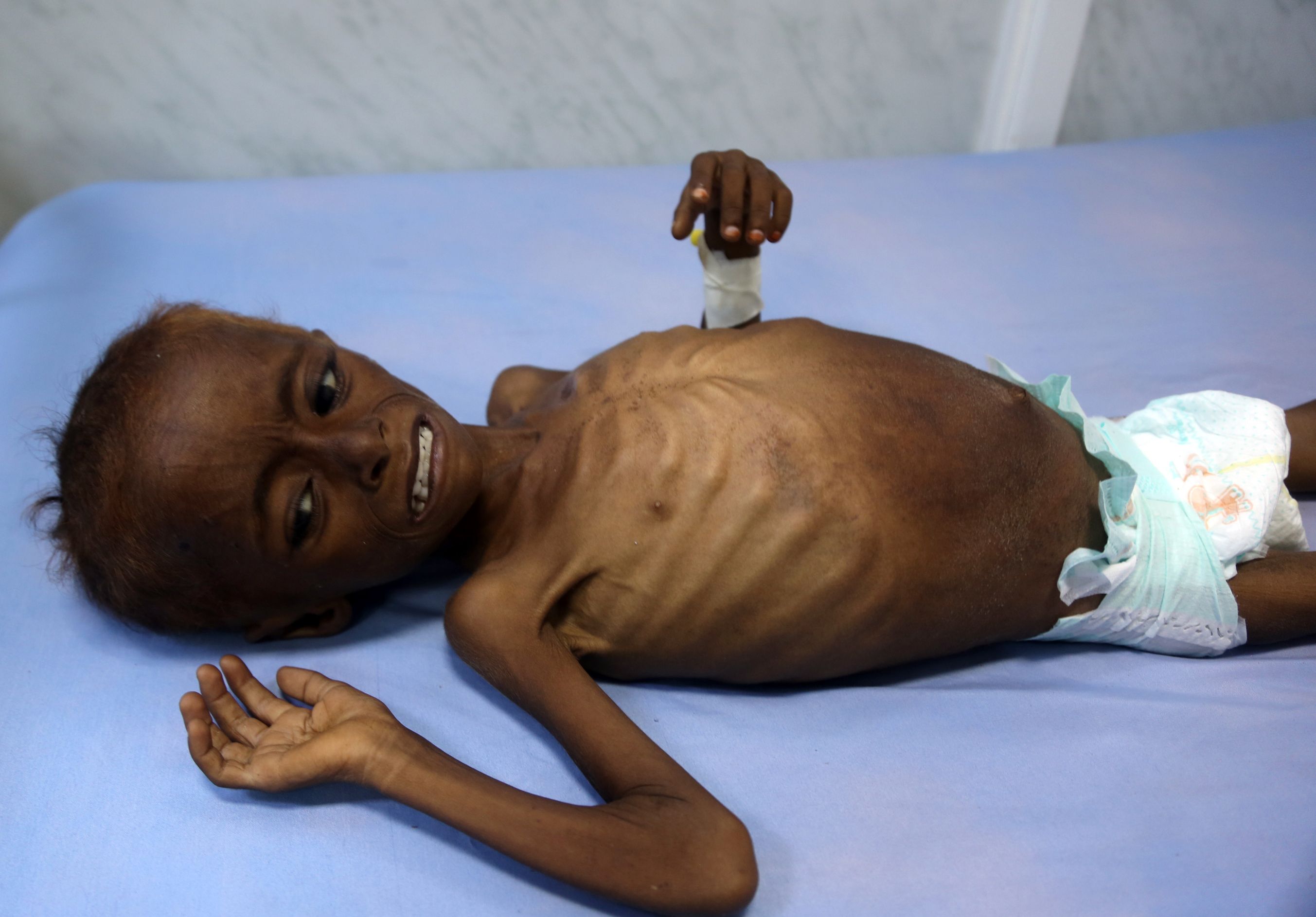 أطفال اليمن يعانون من سوء التغذية