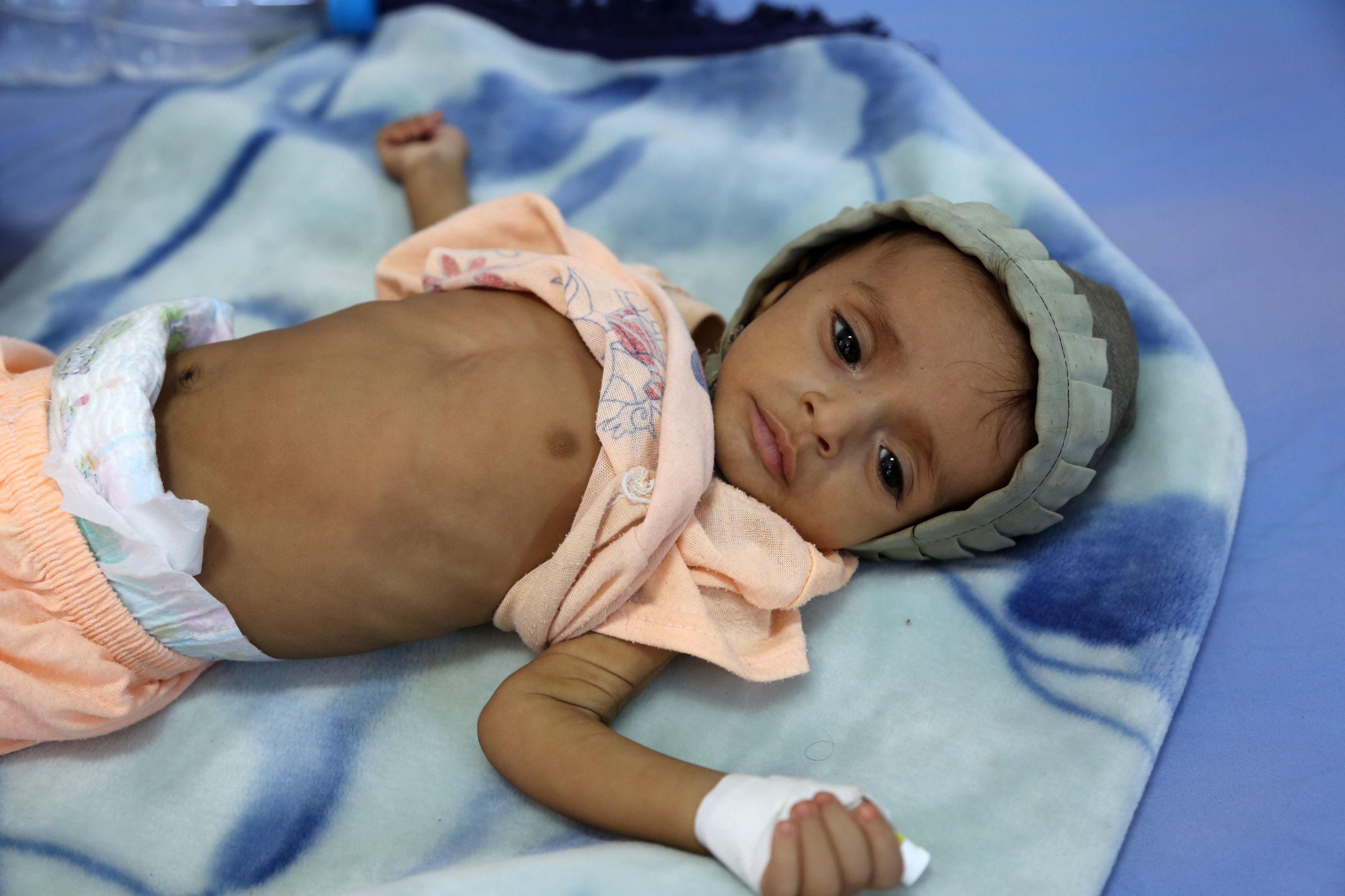 طفلة يمنية فى المستشفى