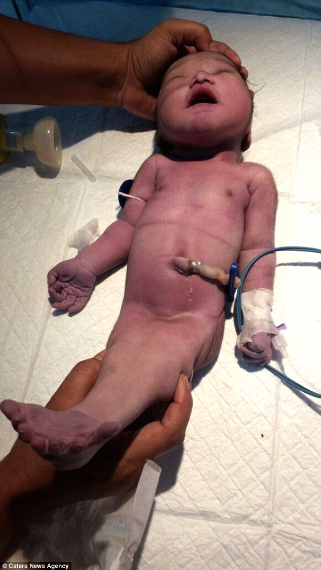 طفل يعانى من متلازمة "حورية البحر" ويموت بعد 4 ساعات