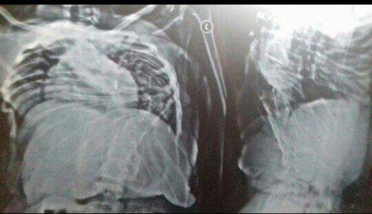 صورة من الأشعة الطبية للحالة