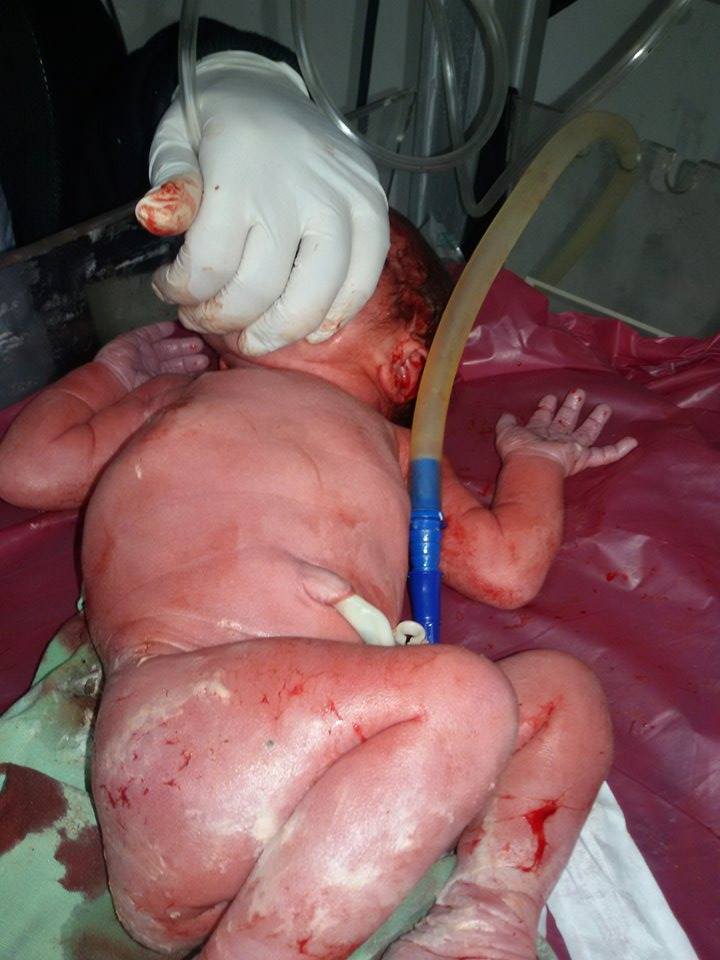 الطفل بعد الولادة مباشرة