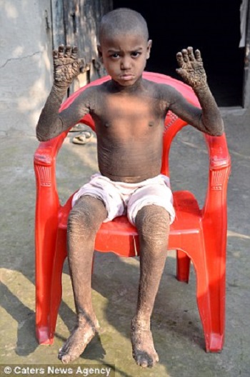 الطفل صاحب المرض النادر يجلس على كرسى احمر