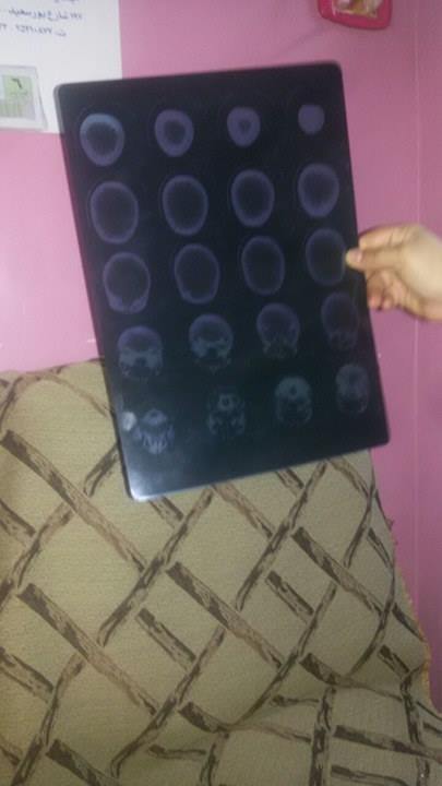 صورة الأشعة المقطعية على المخ
