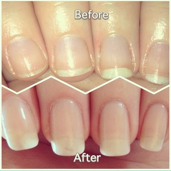 before-and-after-nail-growth