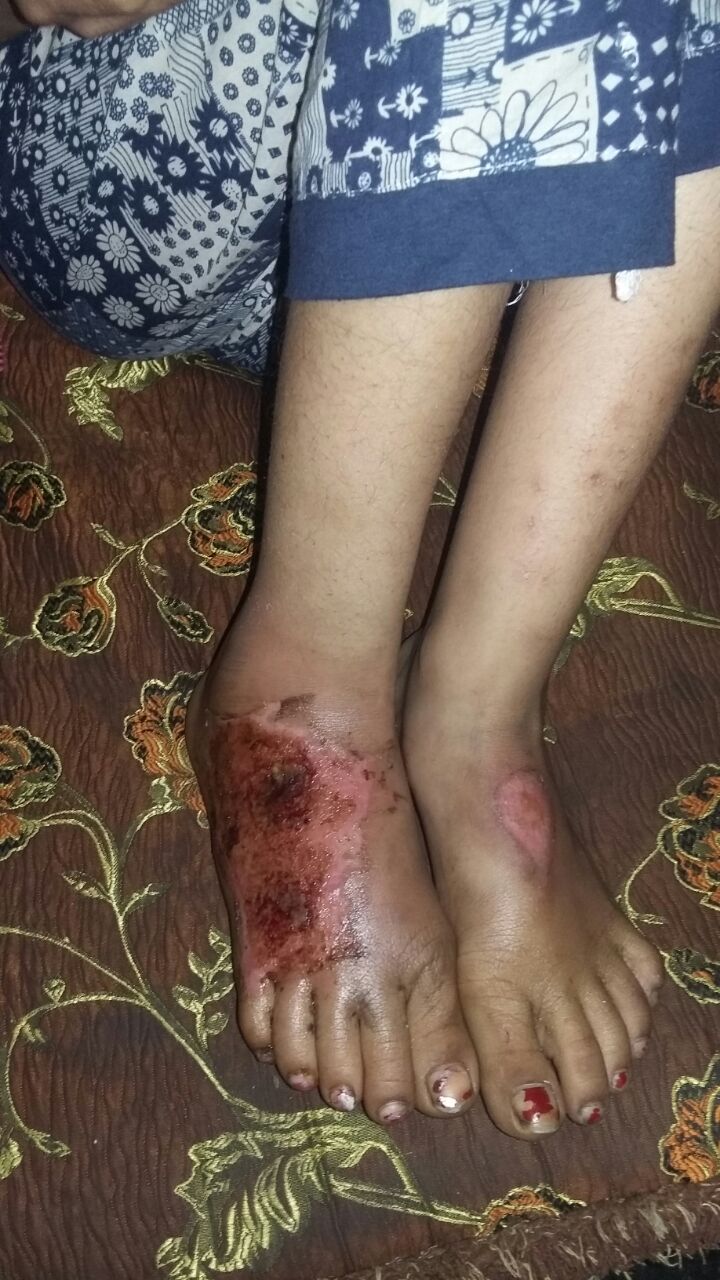 اثار التعذيب