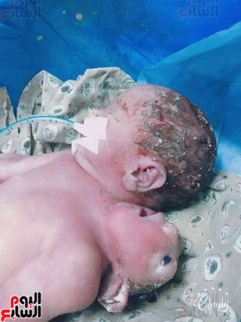 ولادة طفل برأسين وقلبين فى بورسعيد